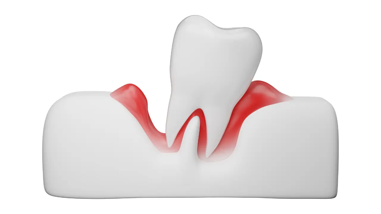 Tooth & Gum Diseases | مسوڑھوں اور دانتوں کی بیماریاں